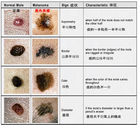 胸部长痣|痣也可能会癌变！长在 3 个地方要注意